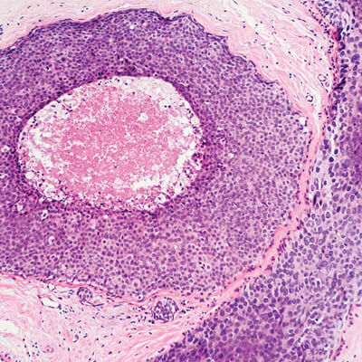 Breast Pathology