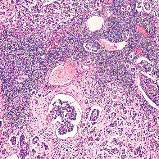 Oakstone CME Breast Pathology