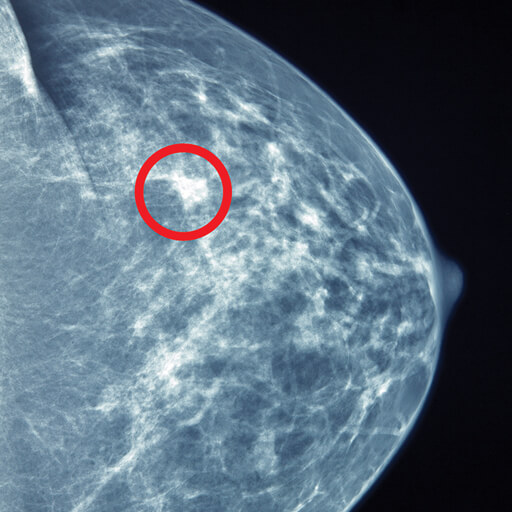 Oakstone CME UCSF Breast Imaging