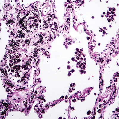 Lung Pathology