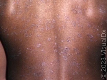 Family Medicine Sample CME Question 3