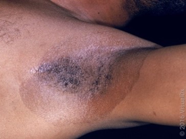 Family Medicine Sample CME Question 4