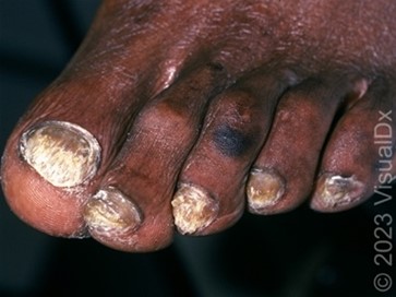 VisualDX Dermatology Sample CME Question 3