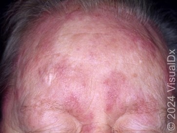 VisualDX Dermatology CME Sample Question 4