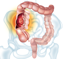 Med-IQ CME: Managing Patients With Colorectal Liver Metastases